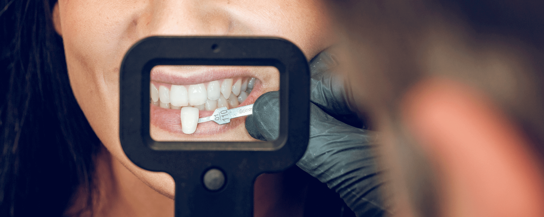 Dental Veneers in Istanbul Turkey Almi Clinic